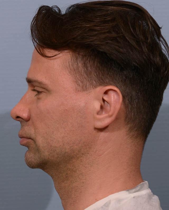 Chin Implant before at Yirae Ort MD Facial Aesthetic Surgery in Bellevue, WA