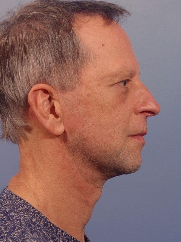 Deep Plane Facelift after at Yirae Ort MD Facial Aesthetic Surgery in Bellevue, WA