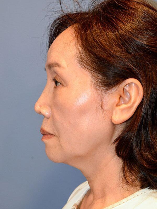 Deep Plane Facelift before at Yirae Ort MD Facial Aesthetic Surgery in Bellevue, WA