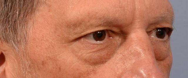 Blepharoplasty before at Yirae Ort MD Facial Aesthetic Surgery in Bellevue, WA