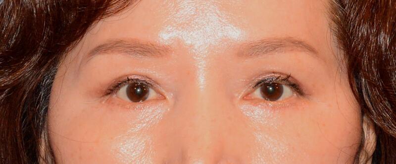 Yirae Ort MD Facial Aesthetic Surgery result — Bellevue, WA