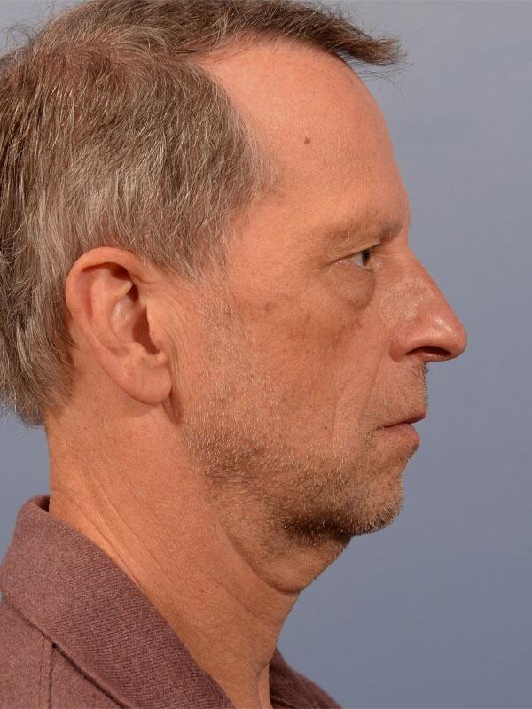 Deep Plane Facelift before at Yirae Ort MD Facial Aesthetic Surgery in Bellevue, WA