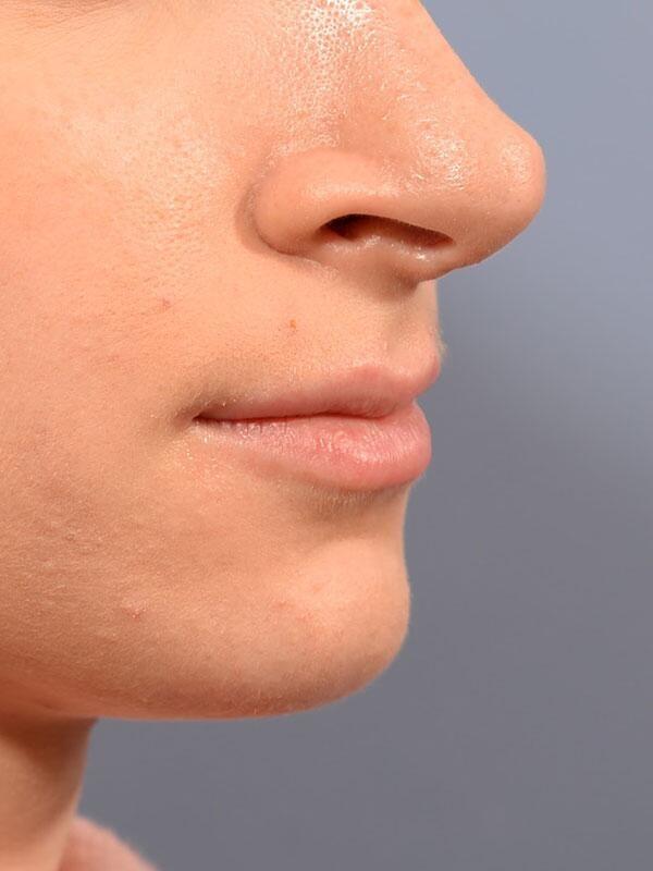 Lip Filler before at Yirae Ort MD Facial Aesthetic Surgery in Bellevue, WA