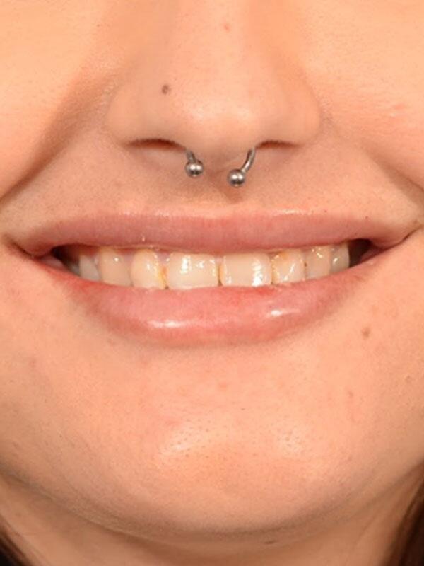 Lip Filler after at Yirae Ort MD Facial Aesthetic Surgery in Bellevue, WA