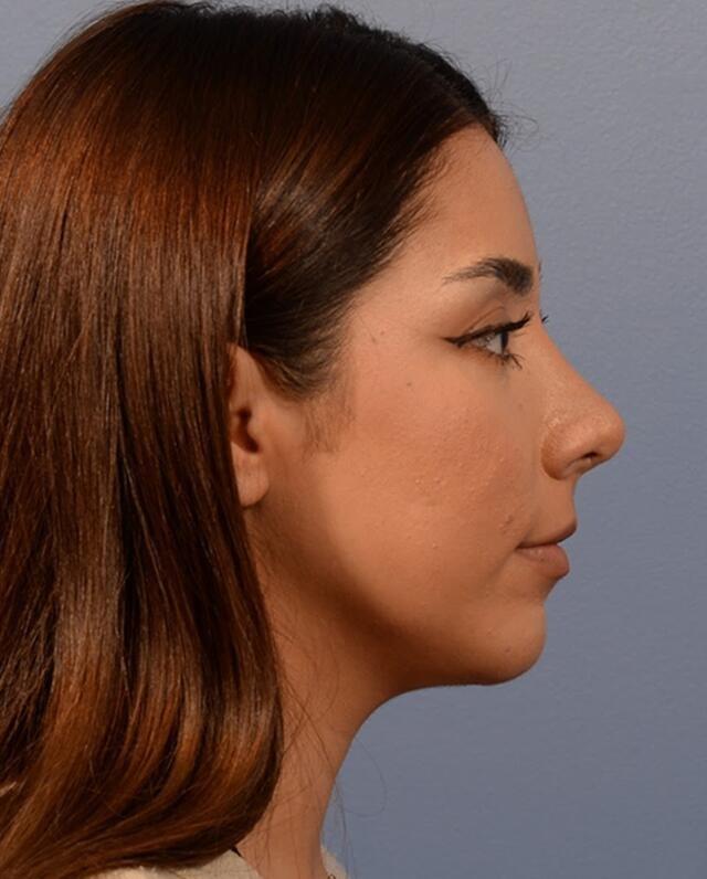 Rhinoplasty after at Yirae Ort MD Facial Aesthetic Surgery in Bellevue, WA