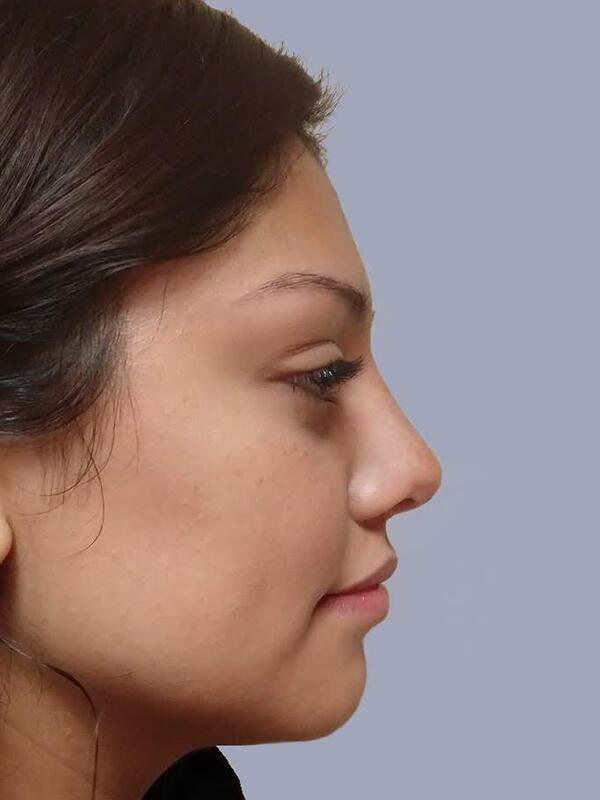 Rhinoplasty after at Yirae Ort MD Facial Aesthetic Surgery in Bellevue, WA