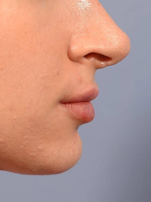 Lip Filler after at Yirae Ort MD Facial Aesthetic Surgery in Bellevue, WA