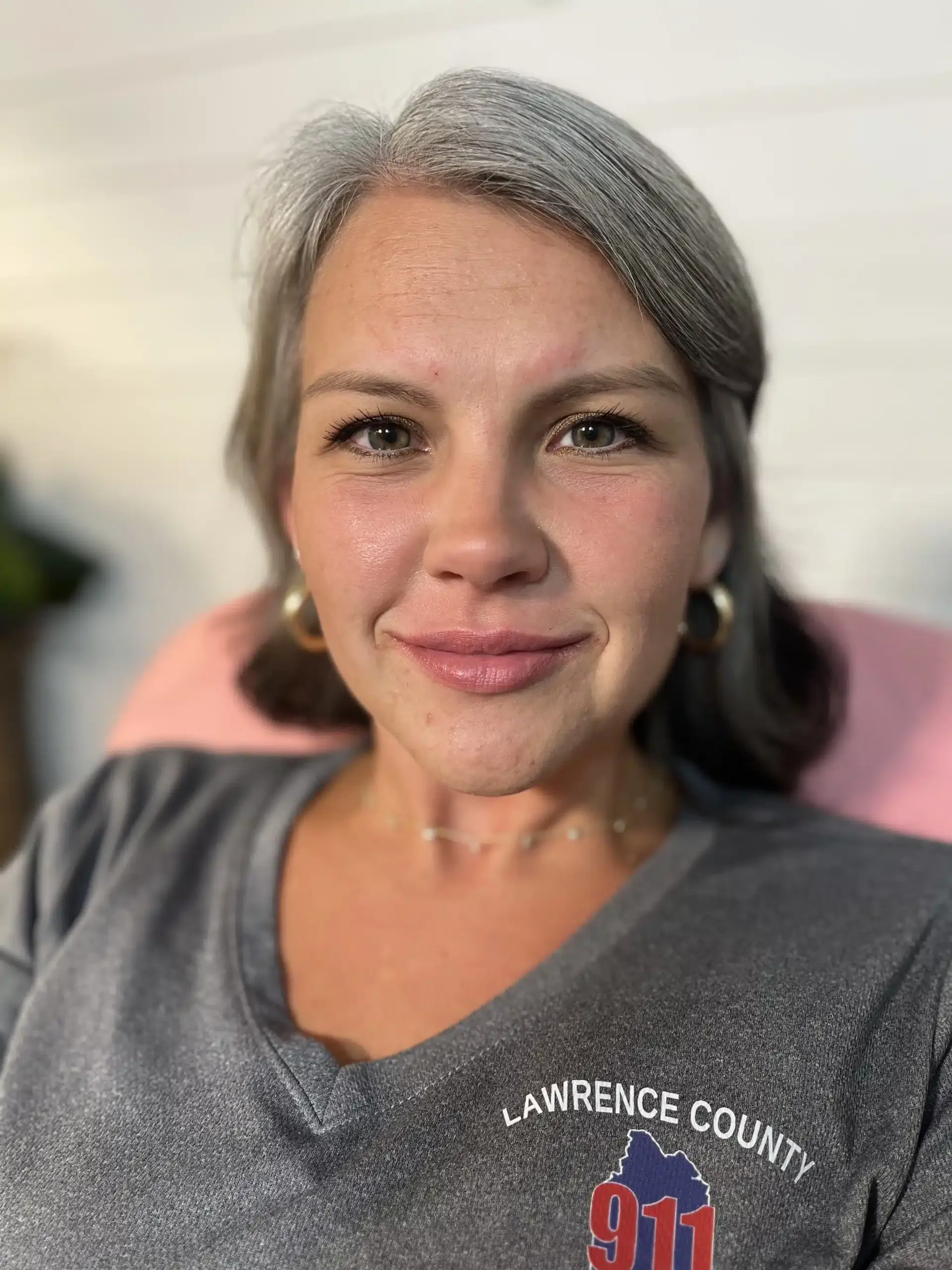 Infinity Med-I-Spa lip filler after — Birmingham, AL