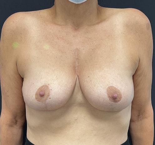 Shwetambara Parakh, MD breast reduction after — Englewood, NJ