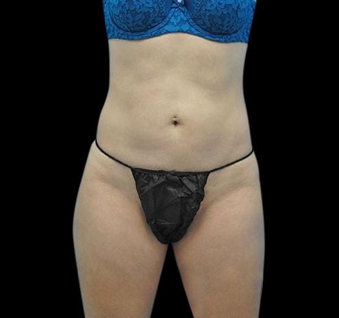 Shwetambara Parakh, MD liposuction after — Englewood, NJ