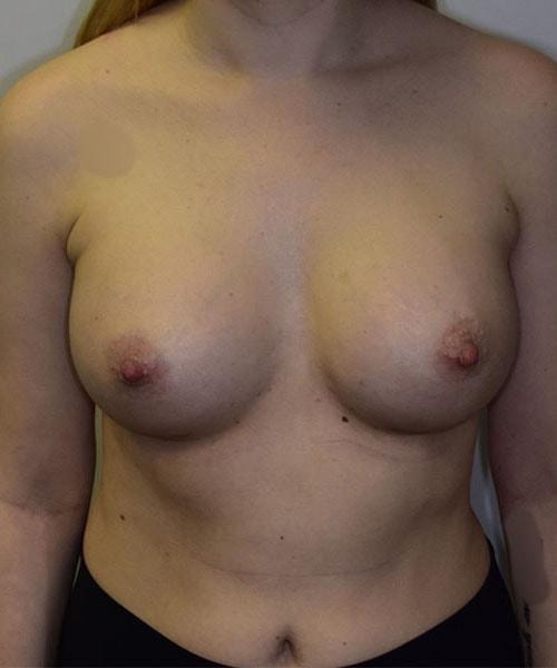 Wellesley Cosmetic Surgery breast augmentation after — Wellesley, MA