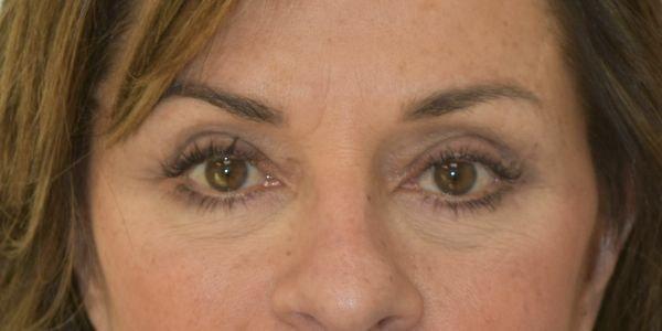 Wellesley Cosmetic Surgery eyelid lift after — Wellesley, MA