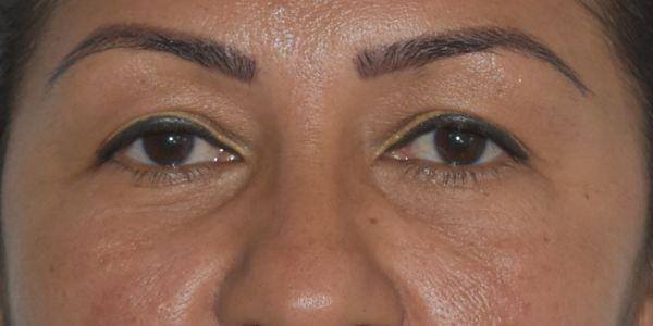 Wellesley Cosmetic Surgery eyelid lift after — Wellesley, MA