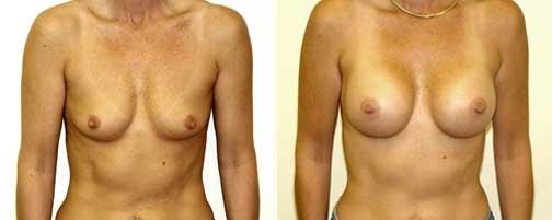 Wellesley Cosmetic Surgery breast augmentation result — Wellesley, MA