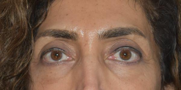 Wellesley Cosmetic Surgery eyelid lift after — Wellesley, MA
