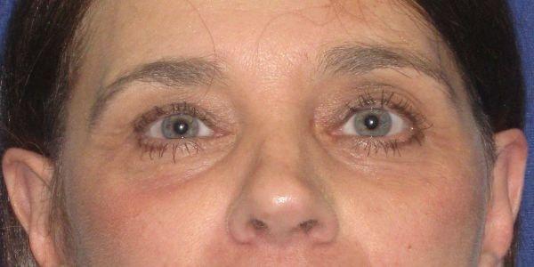 Wellesley Cosmetic Surgery eyelid lift after — Wellesley, MA