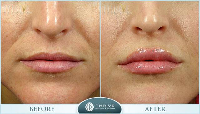Botox result at Thrive Aesthetic & Wellness in Portland, OR