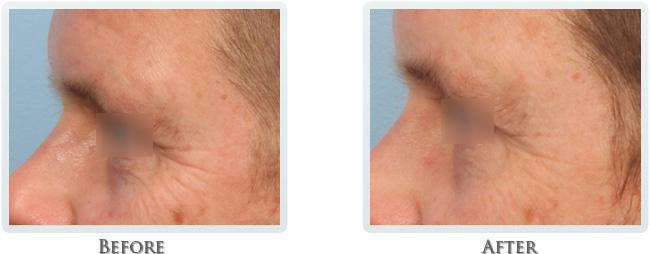 Thrive Aesthetic & Wellness botox result — Portland, OR