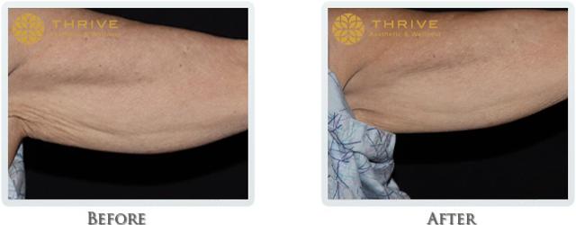 Laser Skin Resurfacing result at Thrive Aesthetic & Wellness in Portland, OR