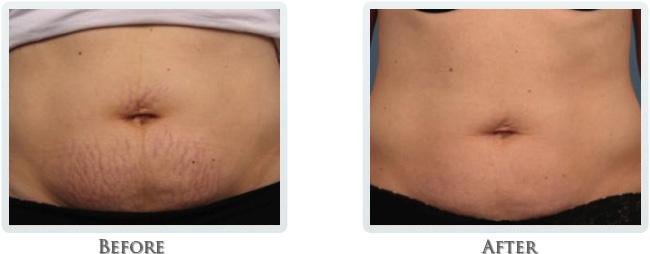 Thrive Aesthetic & Wellness tummy tuck result — Portland, OR