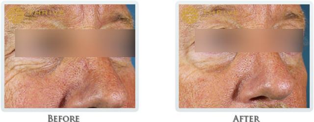 Lip Filler result at Thrive Aesthetic & Wellness in Portland, OR