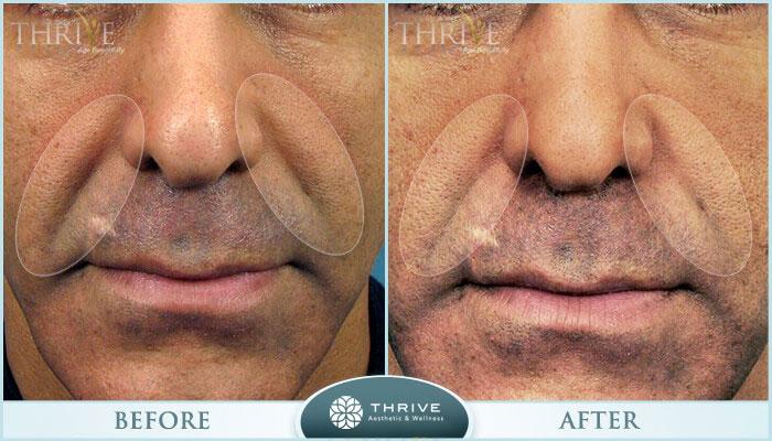 Thrive Aesthetic & Wellness botox result — Portland, OR