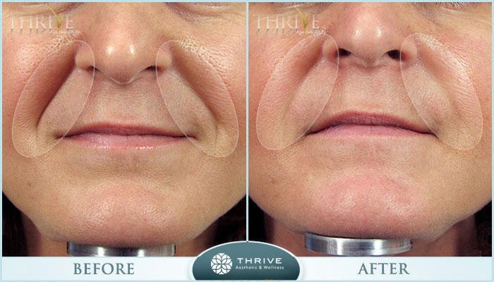Thrive Aesthetic & Wellness botox result — Portland, OR