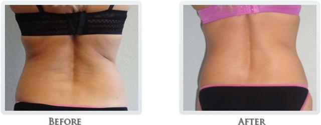 Liposuction result at Thrive Aesthetic & Wellness in Portland, OR