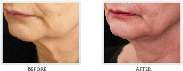 Facelift result at Thrive Aesthetic & Wellness in Portland, OR