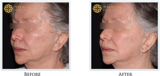 Laser Skin Resurfacing result at Thrive Aesthetic & Wellness in Portland, OR