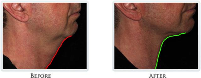 Facelift result at Thrive Aesthetic & Wellness in Portland, OR