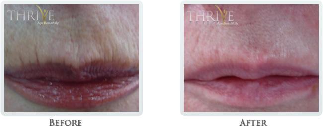 Thrive Aesthetic & Wellness lip filler result — Portland, OR