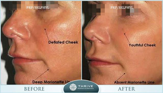 Dermal Fillers result at Thrive Aesthetic & Wellness in Portland, OR