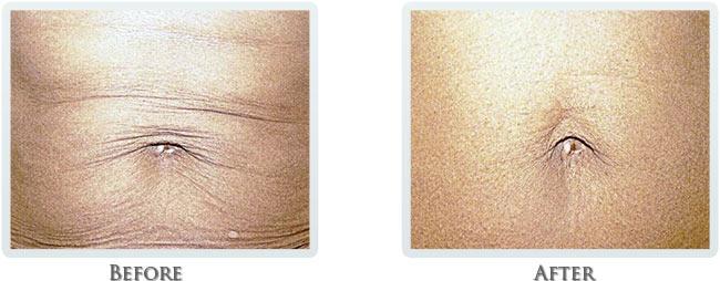 Thrive Aesthetic & Wellness tummy tuck result — Portland, OR