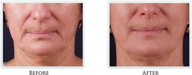 Facelift result at Thrive Aesthetic & Wellness in Portland, OR