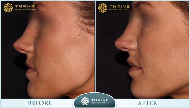 Botox result at Thrive Aesthetic & Wellness in Portland, OR