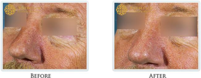 Thrive Aesthetic & Wellness lip filler result — Portland, OR