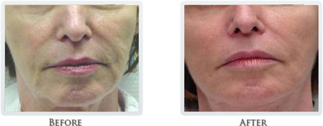 Laser Skin Resurfacing result at Thrive Aesthetic & Wellness in Portland, OR