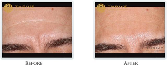 Botox result at Thrive Aesthetic & Wellness in Portland, OR