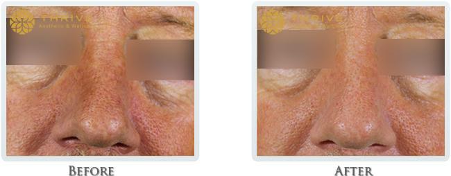 Thrive Aesthetic & Wellness lip filler result — Portland, OR