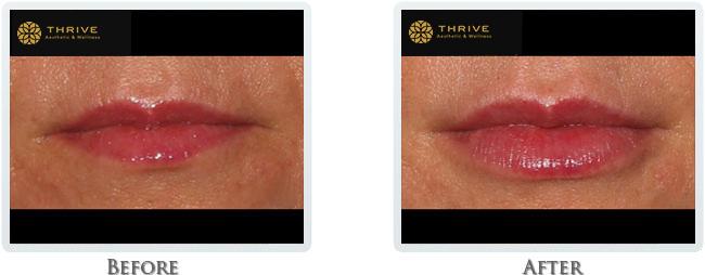 Thrive Aesthetic & Wellness lip filler result — Portland, OR