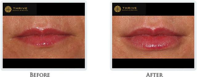 Lip Filler result at Thrive Aesthetic & Wellness in Portland, OR