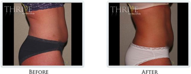 Liposuction result at Thrive Aesthetic & Wellness in Portland, OR