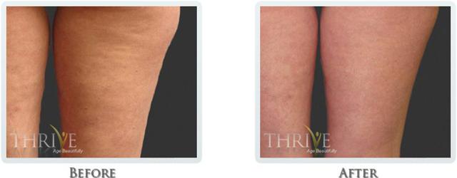 Breast Reduction result at Thrive Aesthetic & Wellness in Portland, OR