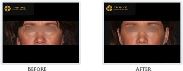 Lip Filler result at Thrive Aesthetic & Wellness in Portland, OR