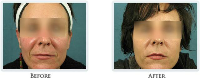 Laser Skin Resurfacing result at Thrive Aesthetic & Wellness in Portland, OR