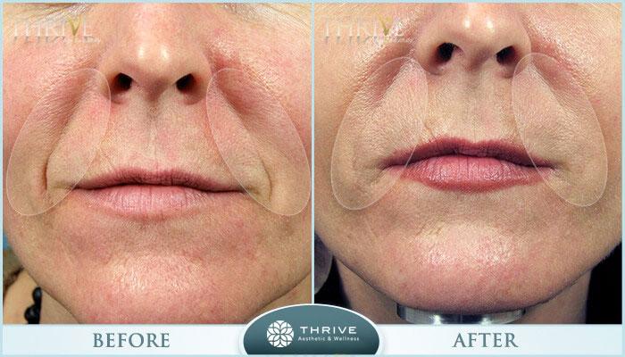 Thrive Aesthetic & Wellness botox result — Portland, OR