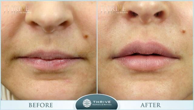 Botox result at Thrive Aesthetic & Wellness in Portland, OR