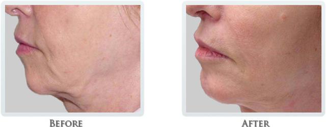 Facelift result at Thrive Aesthetic & Wellness in Portland, OR