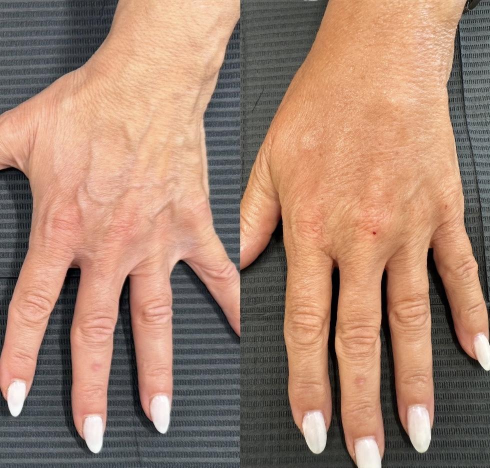 Skinsation OC result — Irvine, CA